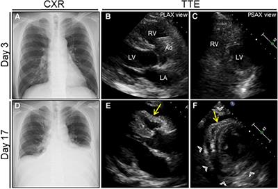 Subacute hemorrhagic pericardial tamponade after COVID-19 infection mimicking carcinomatous pericarditis: a case report